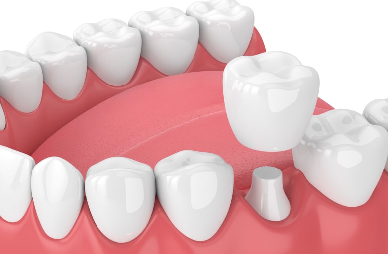 An image of a crowns model