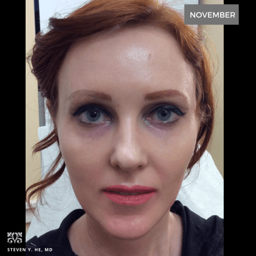 Photo our patient after procedure