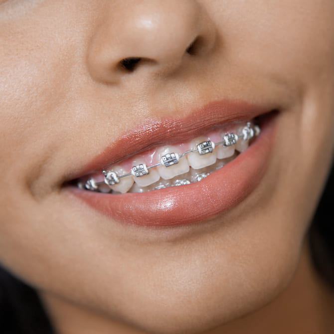 Beautiful smile with braces
