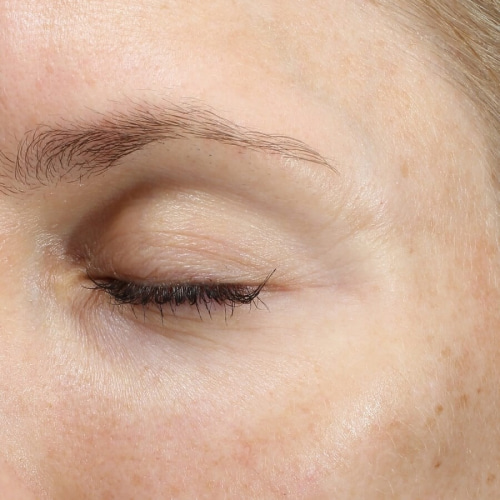 Photo before procedure