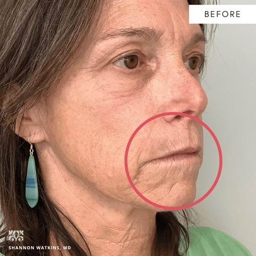 Our patient before procedure