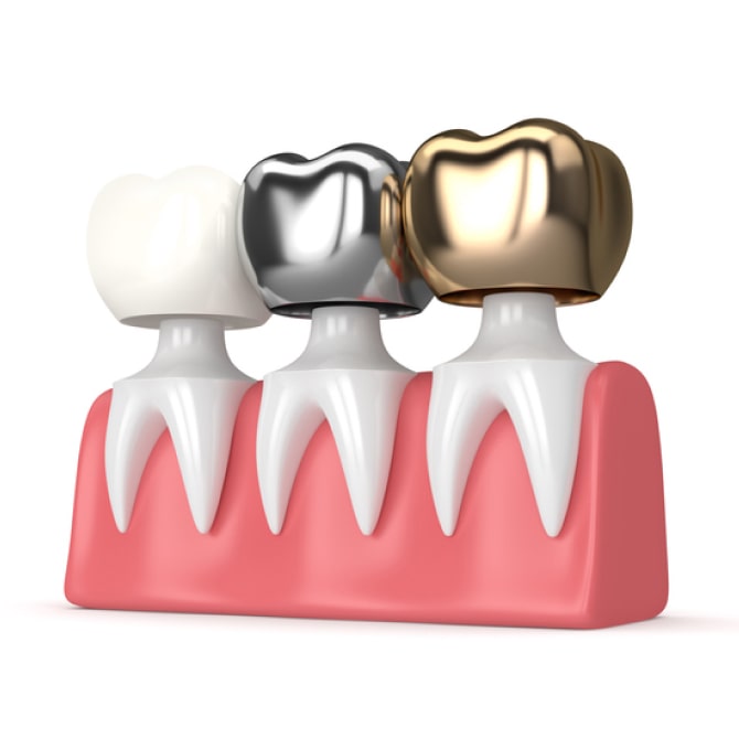 An image of crowns model