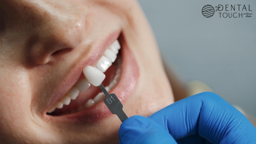 Teeth whitening